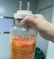 亳州水动力吸脂手术要做多久？